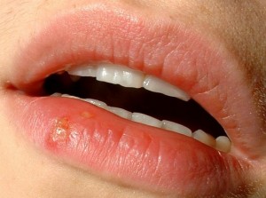 Bolhas na parte interna da boca