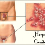 Herpes genital: causas, sintomas, transmissão, tratamento e prevenção.