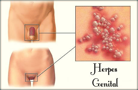 Herpes genital: causas, sintomas, transmissão, tratamento e prevenção.