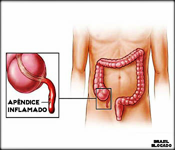 Apendicite aguda: causas e tratamento conservador