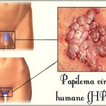 HPV: causas, sintomas, transmissão, tratamento, prevenção e vacinação.