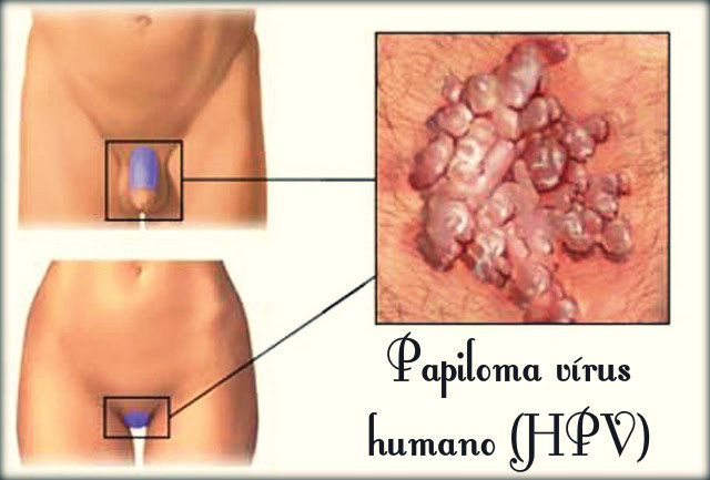 HPV: causas, sintomas, transmissão, tratamento, prevenção e vacinação.