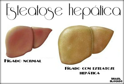 Esteatose hepática 3° grau: causas, sintomas, tratamento, prevenção.