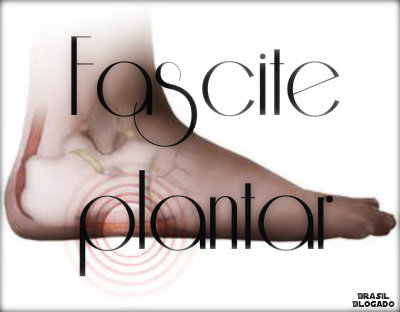 Fascite plantar: causas, sintomas, tratamento e prevenção.