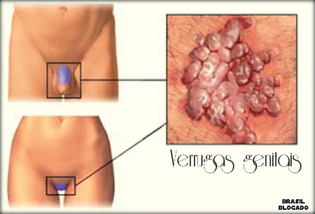 HPV de alto risco