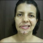Paralisia Facial Periférica