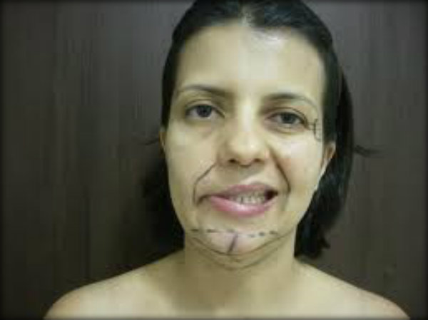 Paralisia Facial Periférica