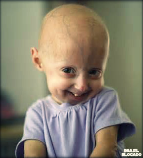 Progeria: causas, sintomas, diagnóstico, tratamento e complicações possíveis.