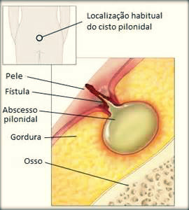 Cisto pilonidal: causas, sintomas e tratamento