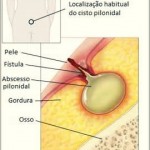Cisto pilonidal: causas, sintomas e tratamento