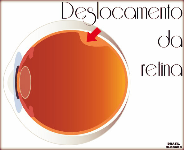 Deslocamento da retina: causas, sintomas, tratamento e prevenção.
