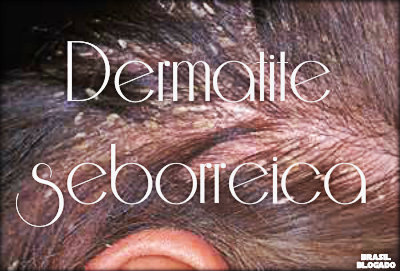 Dermatite seborreica: causas, sintomas, tratamento e prevenção.