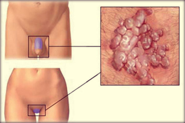 HPV: causas, sintomas, tratamento e prevenção.