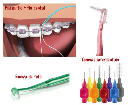 A imagem demonstra como passar o fio dental com ajuda da agulha descartável. E mostra também diversos modelos de escovas. 