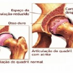 A foto reproduz a cartilagem desgastada de um quadril.