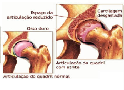 A foto reproduz a cartilagem desgastada de um quadril.