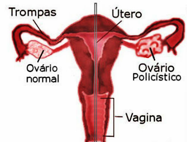 Os exames semestrais no ginecologista, pode ajudar na descoberta. 
