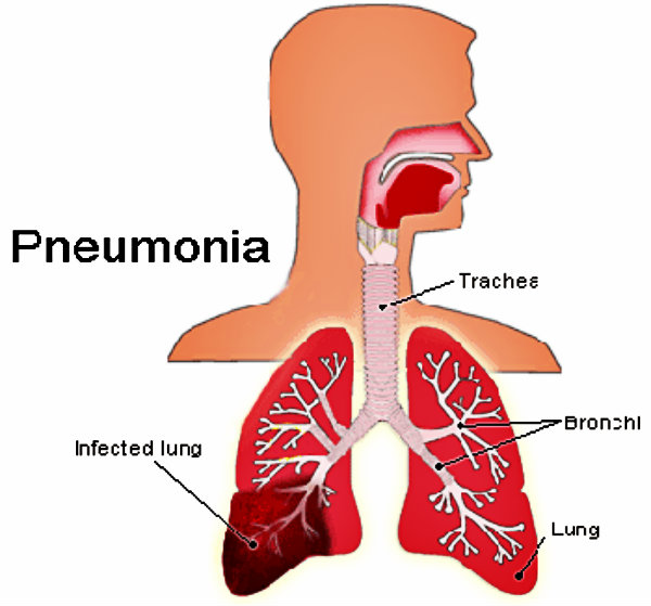 O seu principal sintoma é a febre e secreção nos pulmões.